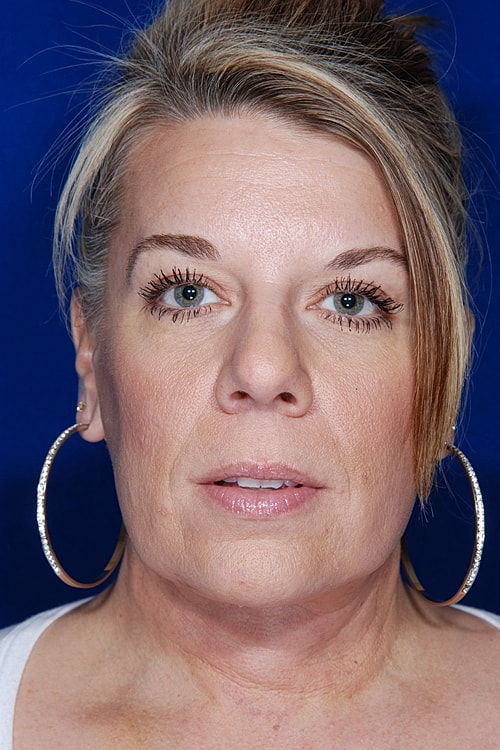 Facelift Before & After