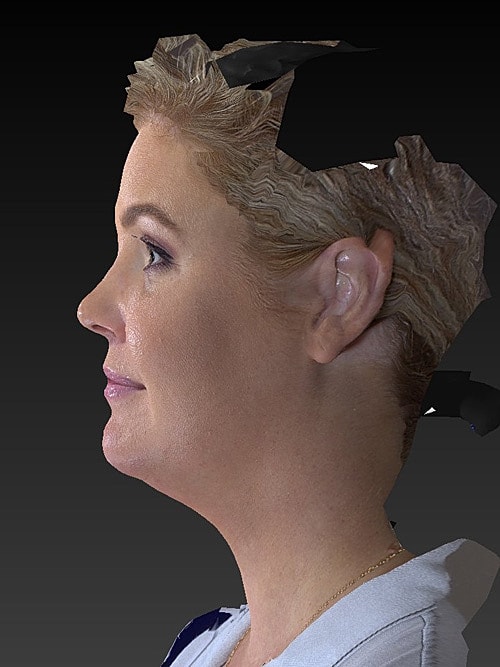 Facelift Before & After