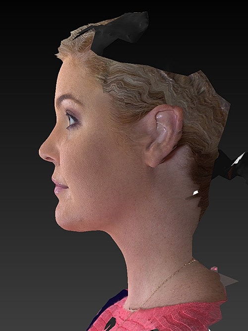 Facelift Before & After