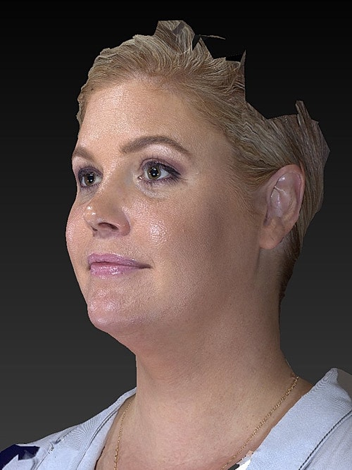 Facelift Before & After