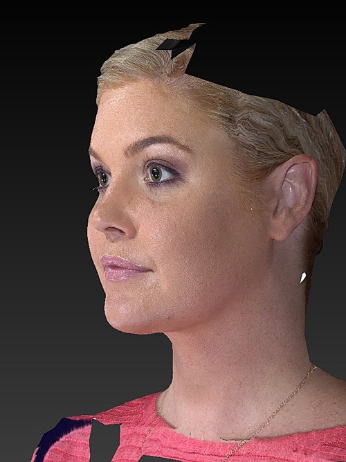 Facelift Before & After