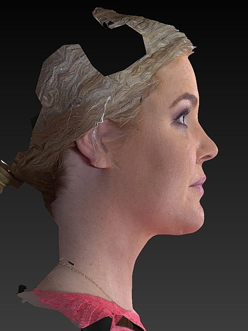 Facelift Before & After