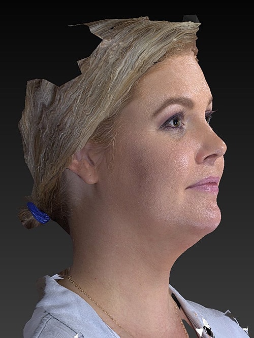 Facelift Before & After