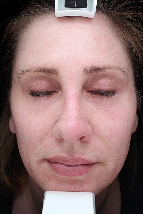 Facelift Before & After