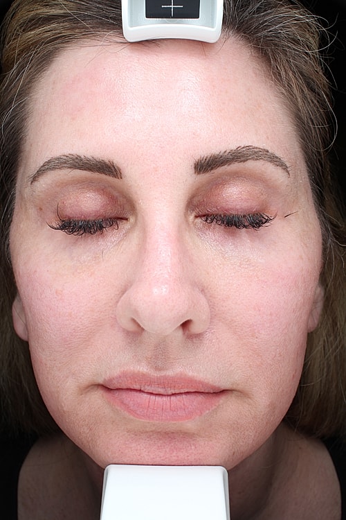 Facelift Before & After