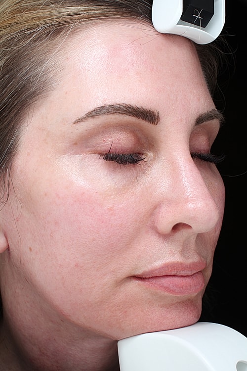 Facelift Before & After