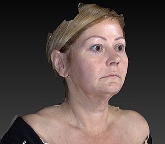 Facelift Before & After