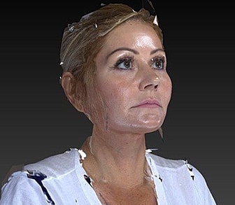 Facelift Before & After