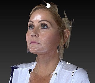 Facelift Before & After