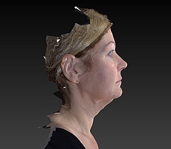 Facelift Before & After