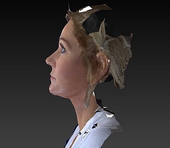 Facelift Before & After