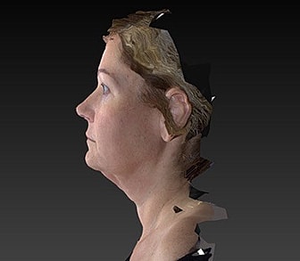 Facelift Before & After