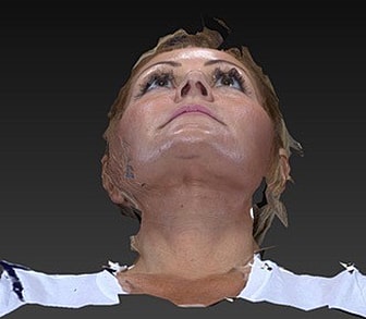 Facelift Before & After