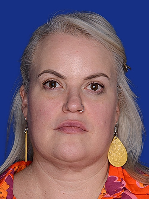 Facelift Before & After