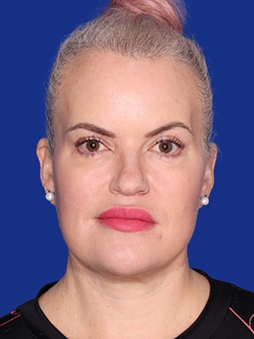 Facelift Before & After