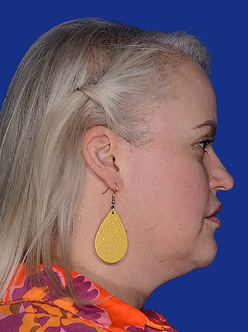 Facelift Before & After