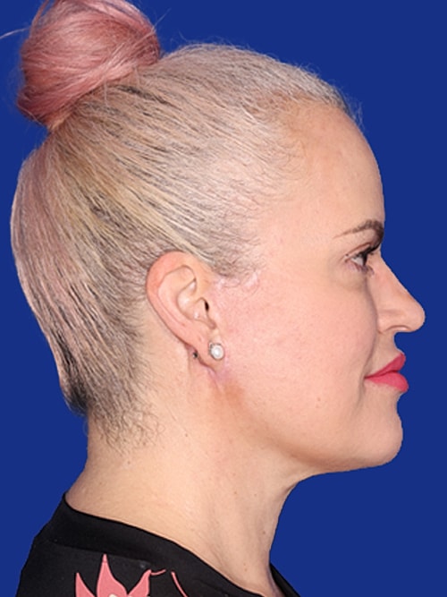 Facelift Before & After