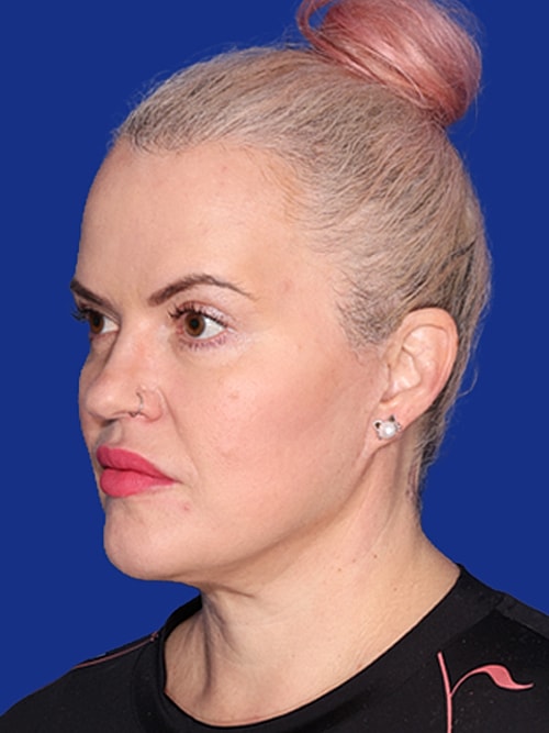 Facelift Before & After