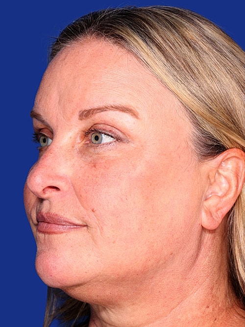 Facelift Before & After