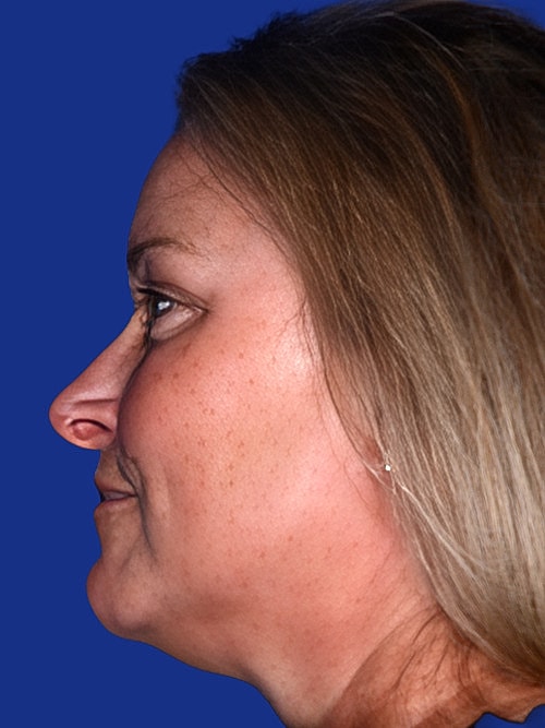 Facelift Before & After