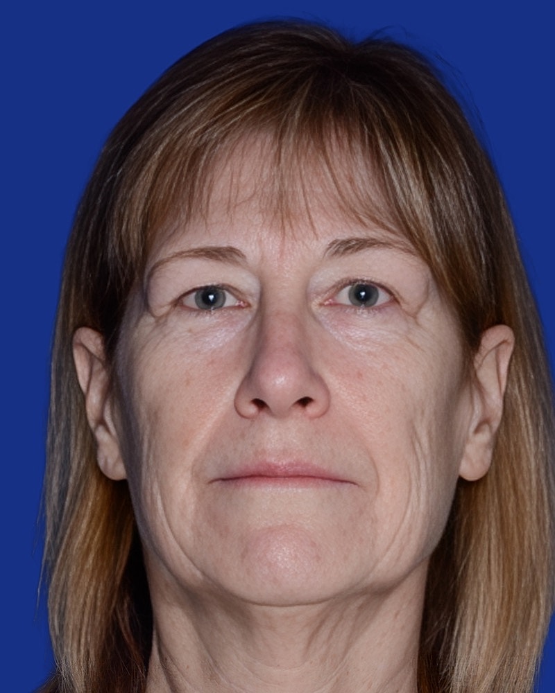 Facelift Before & After