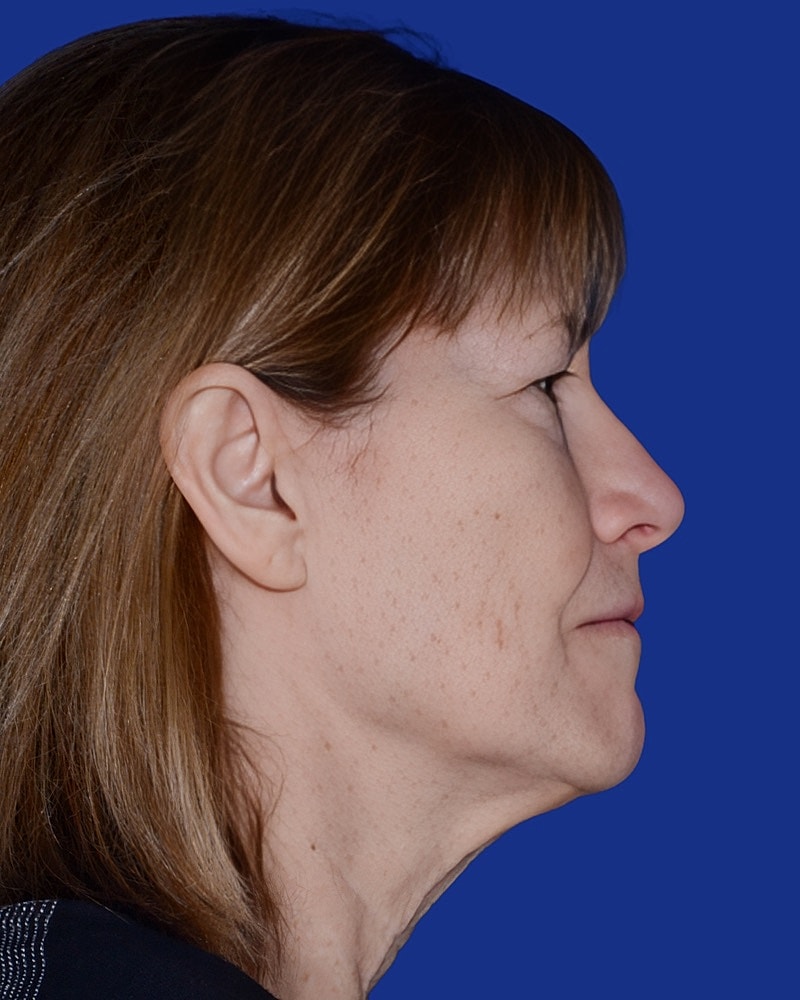 Facelift Before & After