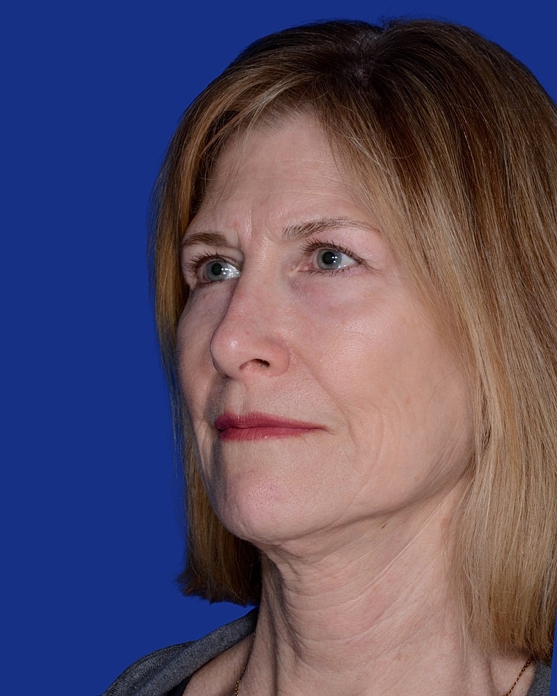 Facelift Before & After