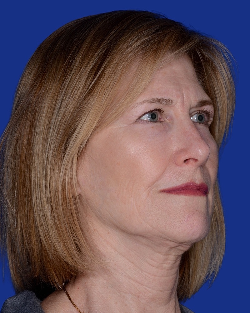 Facelift Before & After