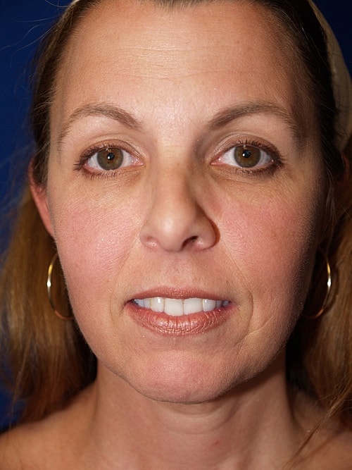 Facelift Before & After