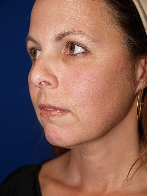 Facelift Before & After
