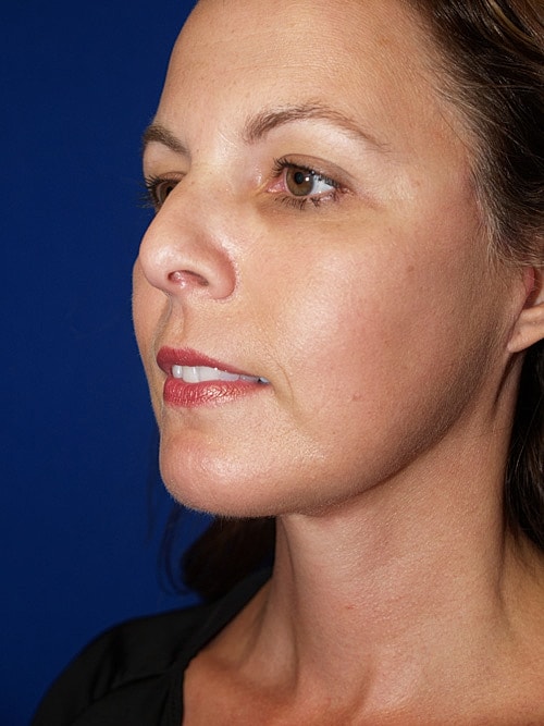 Facelift Before & After