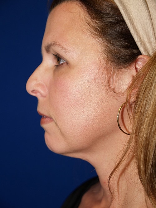 Facelift Before & After