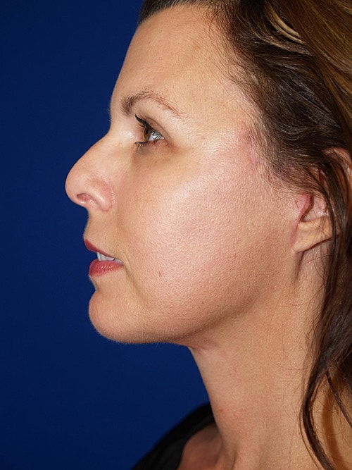 Facelift Before & After