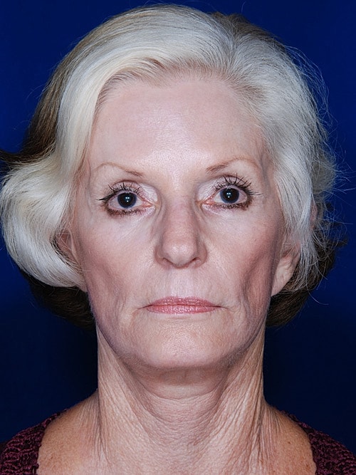 Facelift Before & After