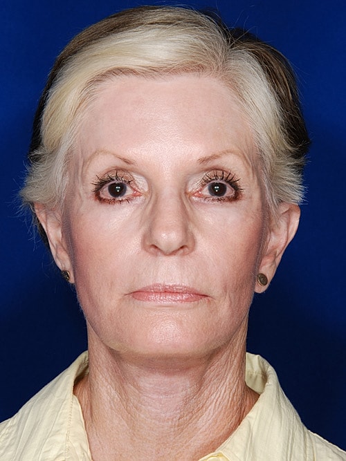 Facelift Before & After