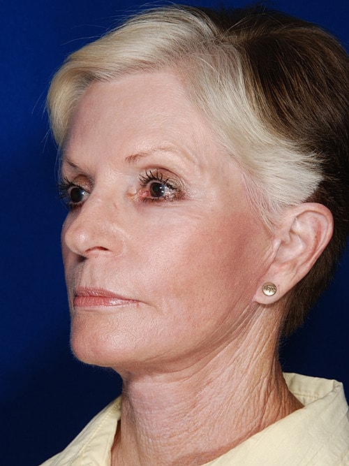 Facelift Before & After