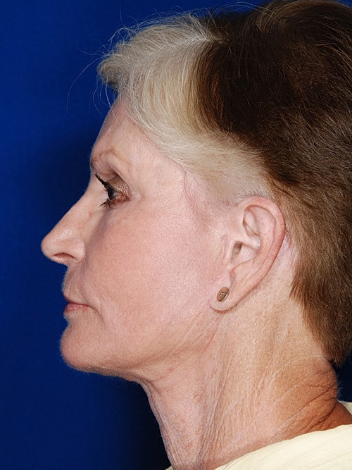 Facelift Before & After