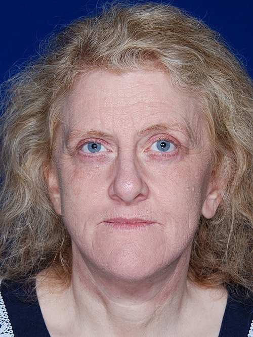 Facelift Before & After