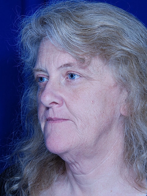 Facelift Before & After
