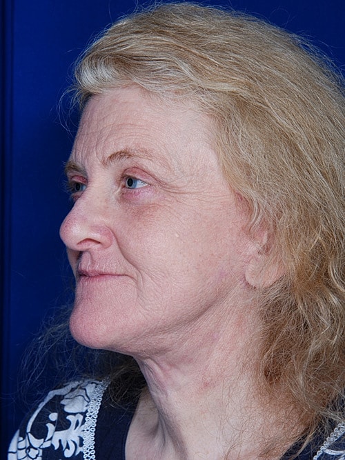 Facelift Before & After