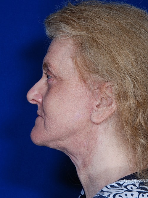 Facelift Before & After
