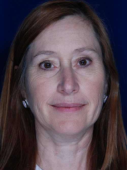 Facelift Before & After