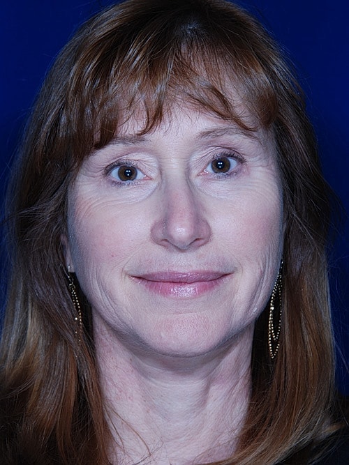 Facelift Before & After
