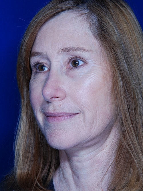 Facelift Before & After