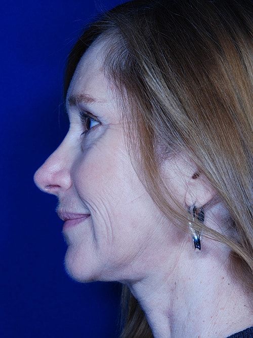 Facelift Before & After