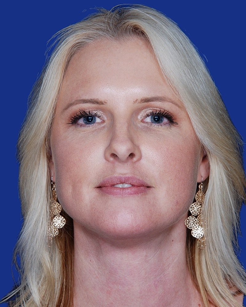 Facelift Before & After