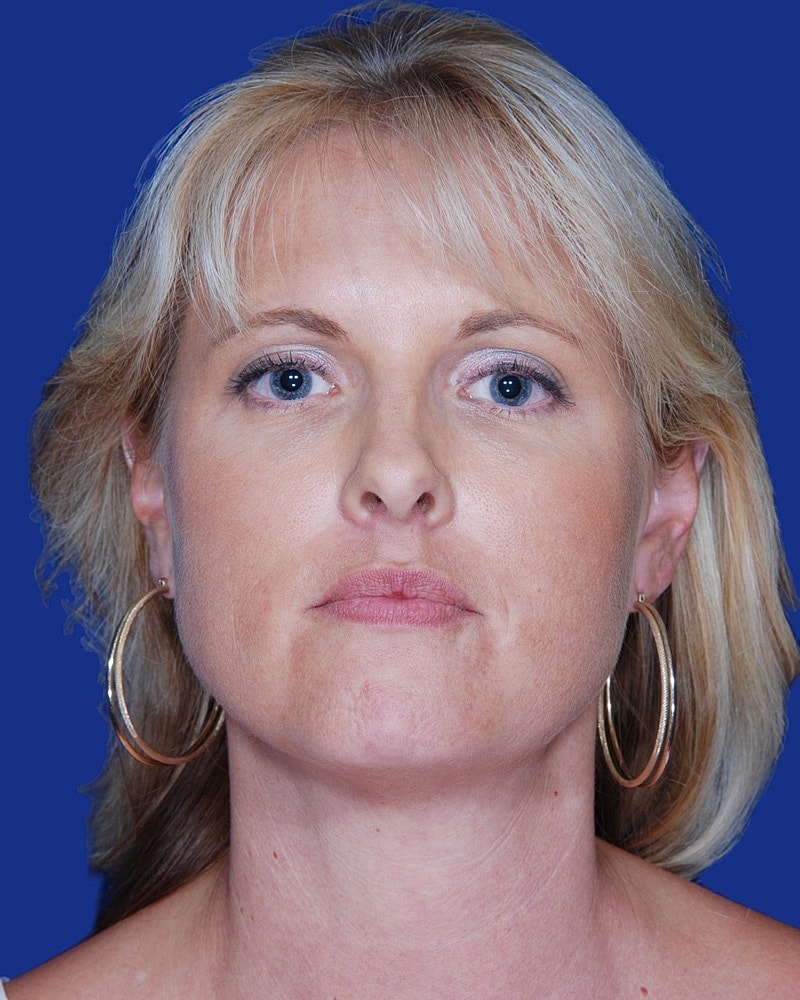 Facelift Before & After
