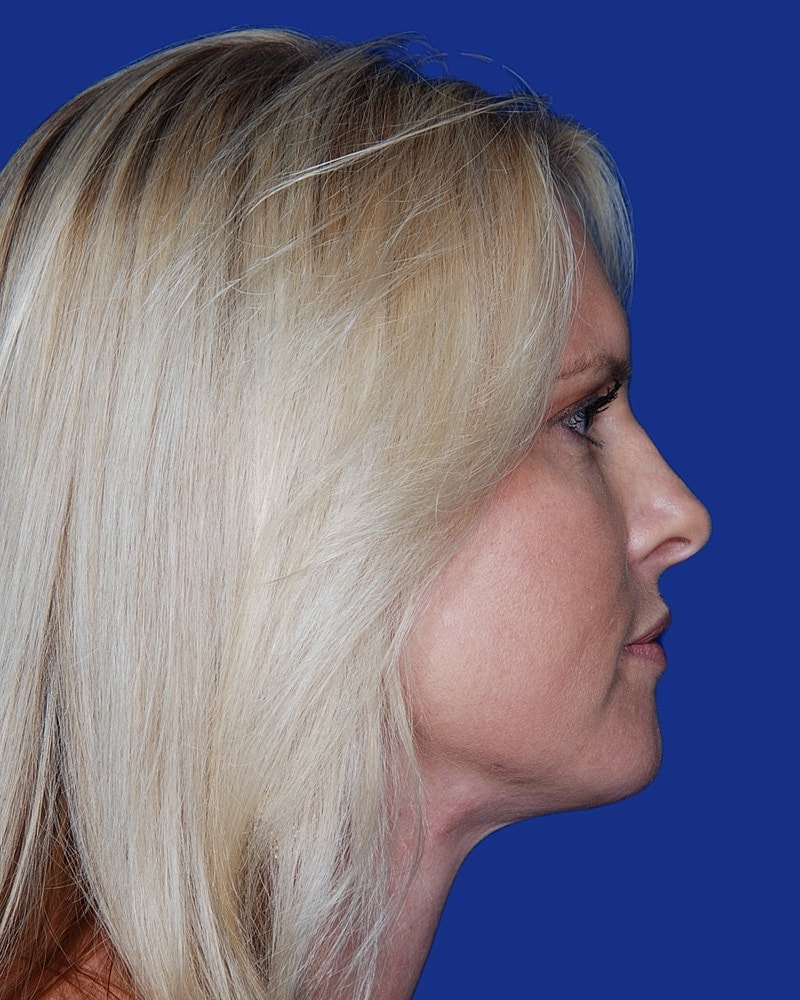 Facelift Before & After