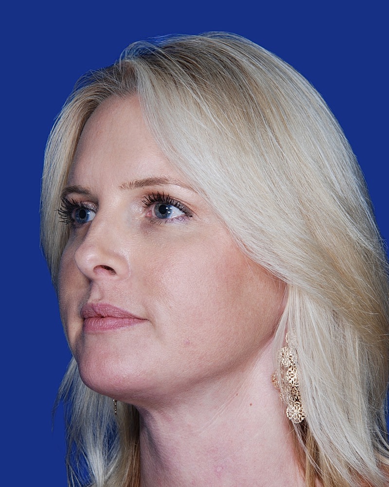 Facelift Before & After