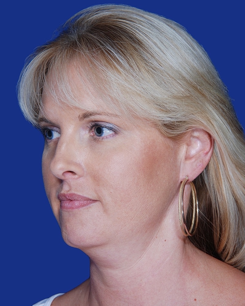 Facelift Before & After